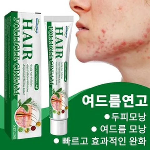 여드름연고 여드름치료 등드름/피부/얼굴 여드름약 HM009, 2개