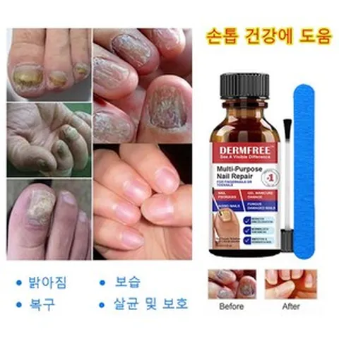 발톱무좀 에센스 손톱 강화제 손톱영양제 문제성 손발톱 종합관리 손발톱 네일 솔루션 풋 케어 앰플, 1개, 30ml