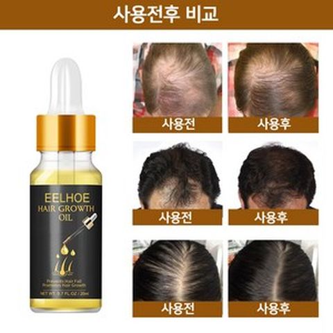 [당일 배송]EELHOE 모발 성장 에센스|모공 소통|탈모 예방|대머리 치료치료 : 원형 탈모증 정수리 탈모증 M자형 탈모증W022, 1개, 20ml
