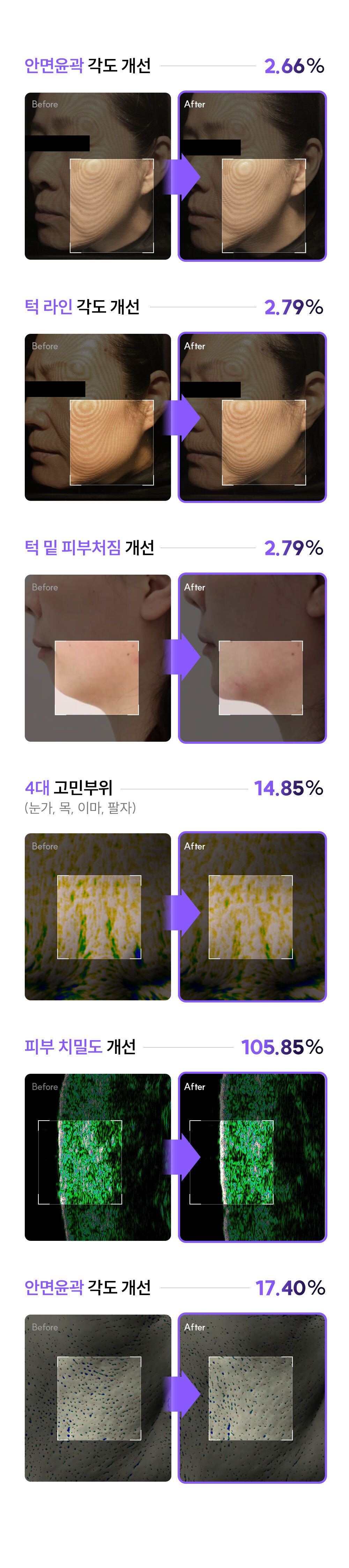 EOA 풀쎄라 프로 (기기 세트)