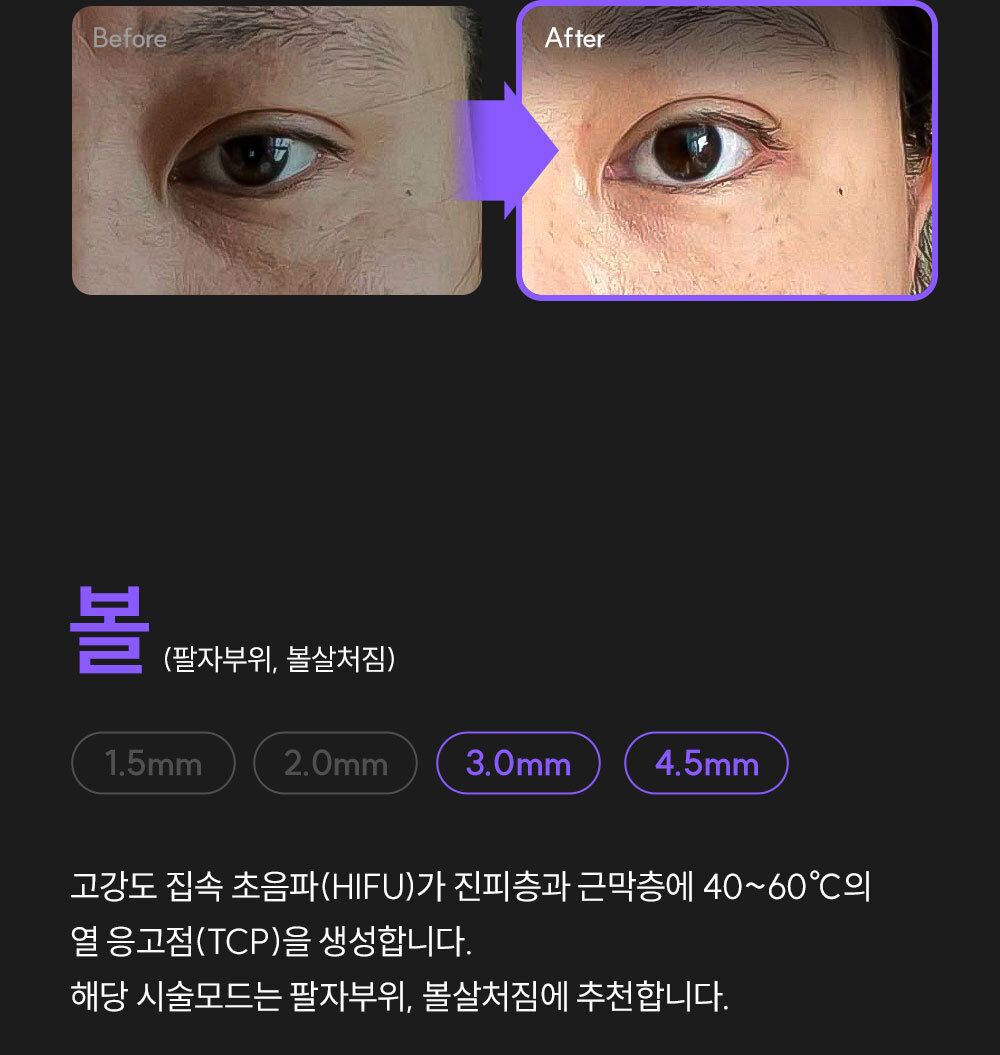 EOA 풀쎄라 프로 (기기 세트)