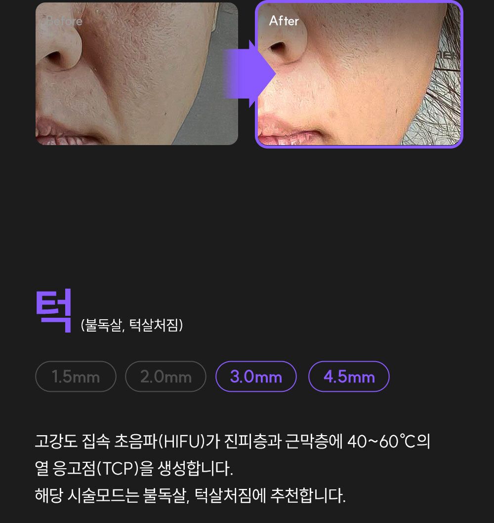 EOA 풀쎄라 프로 (기기 세트)