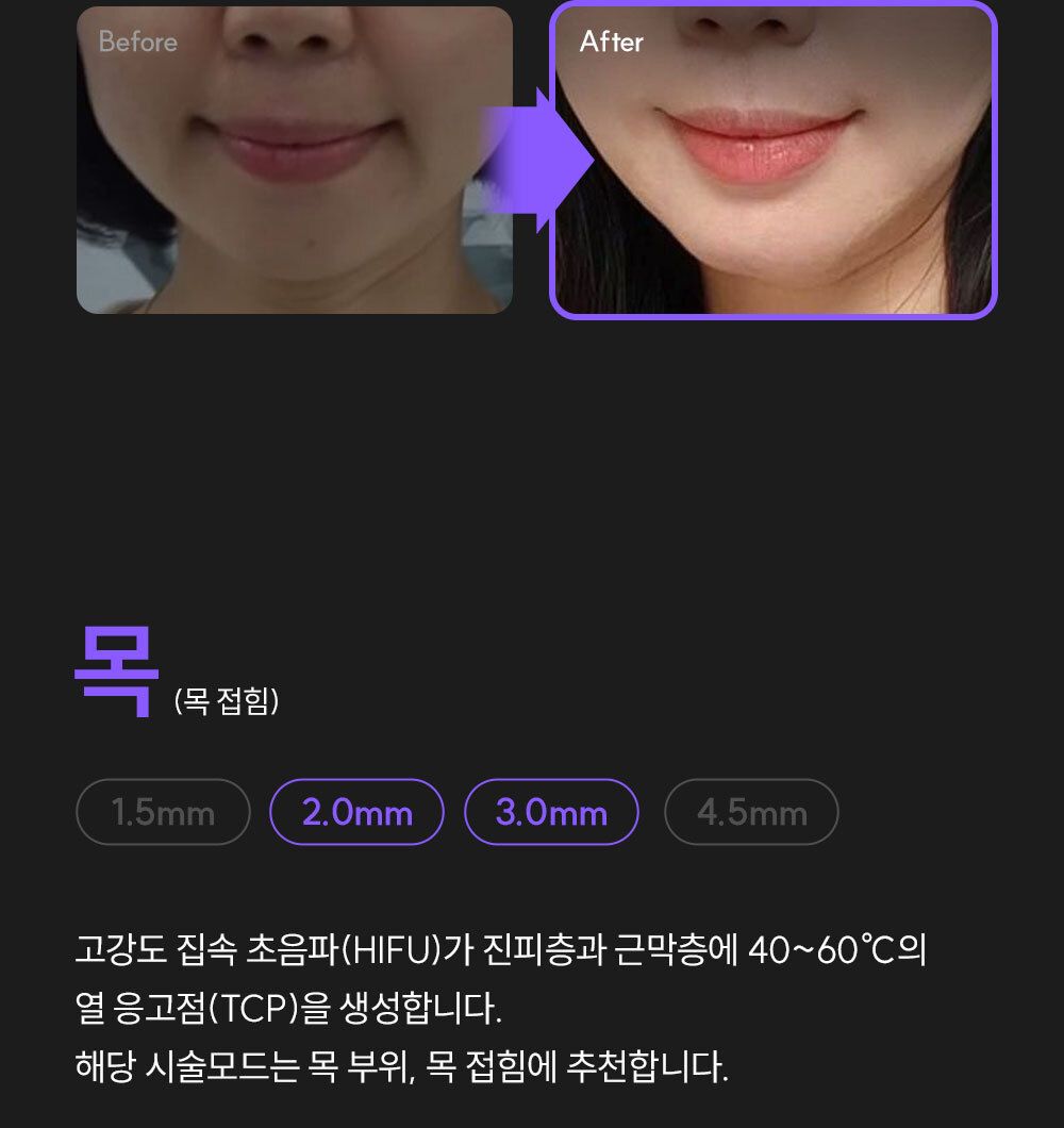 EOA 풀쎄라 프로 (기기 세트)