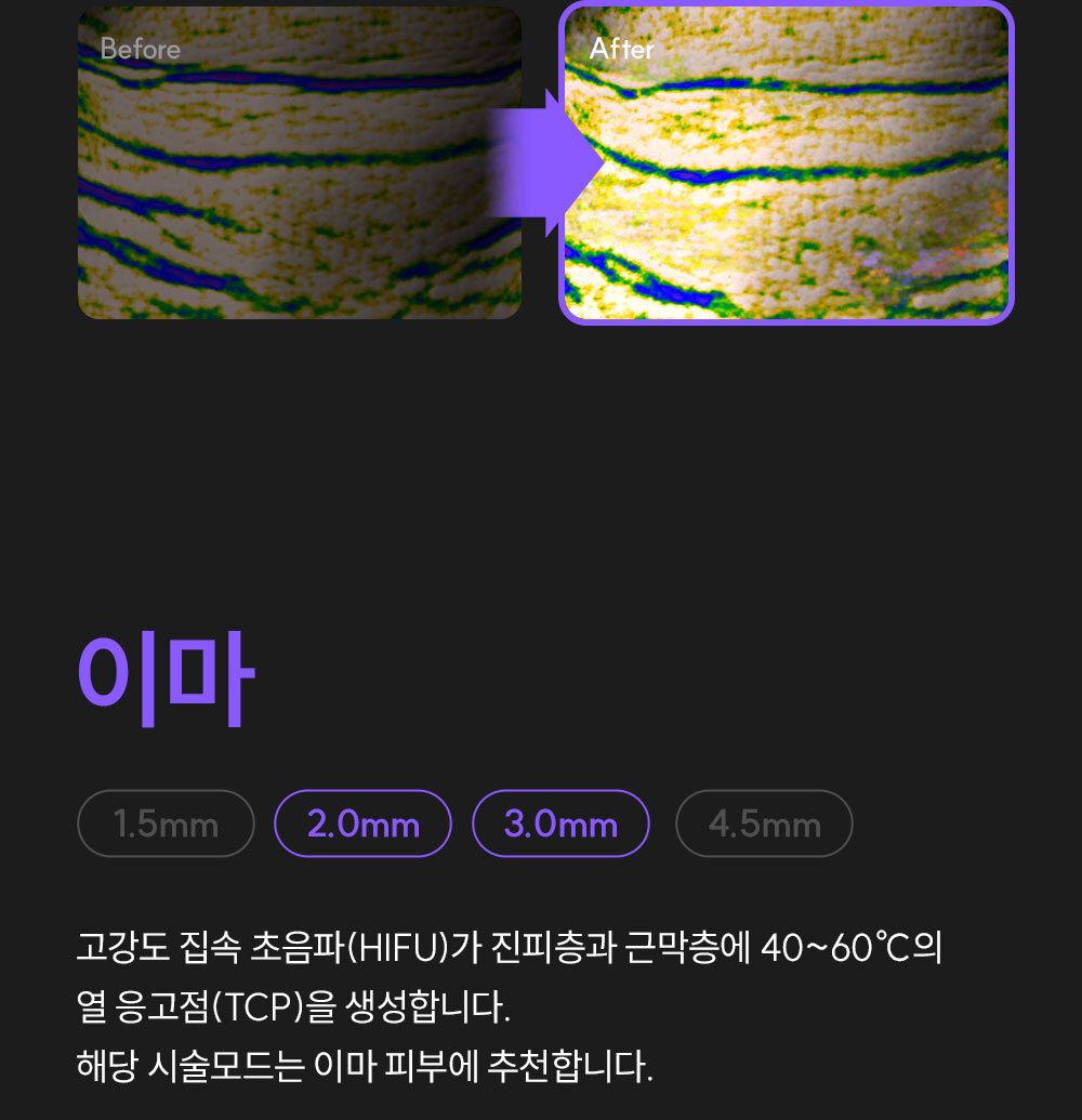 EOA 풀쎄라 프로 (기기 세트)